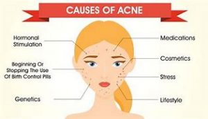 Causes and Effects Of Acne