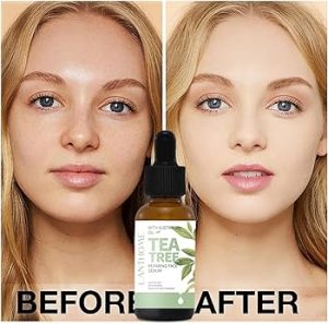 Natural Acne Treatment 101